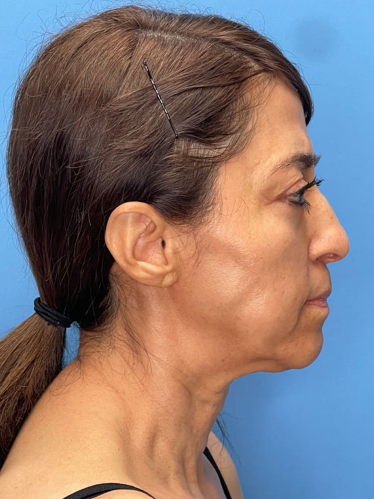 Brow Lift Before & After Image