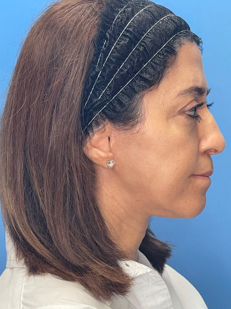 Brow Lift Before & After Image