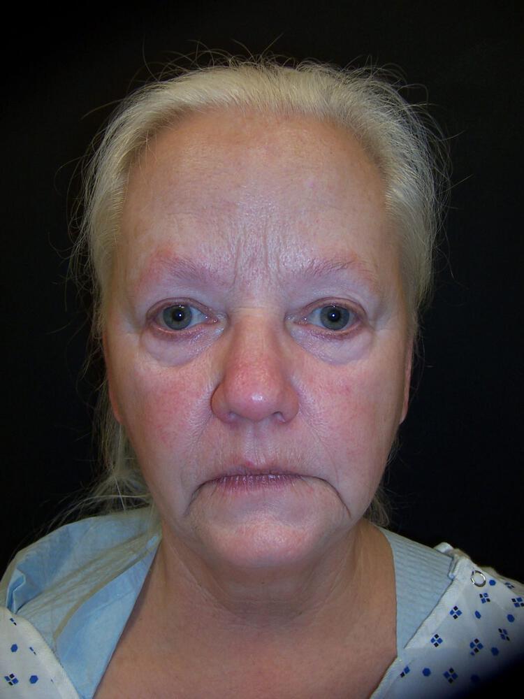 Deep Plane Facelift (Contour Lift) Before & After Image