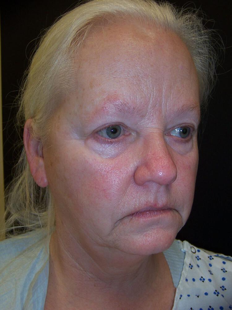 Deep Plane Facelift (Contour Lift) Before & After Image