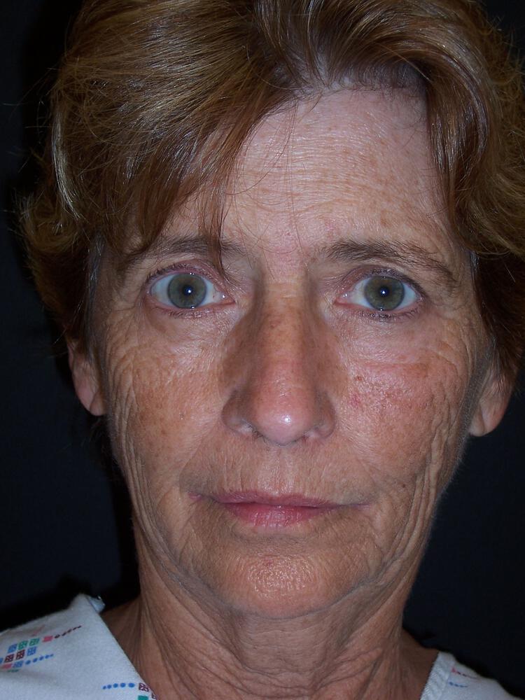 Deep Plane Facelift (Contour Lift) Before & After Image