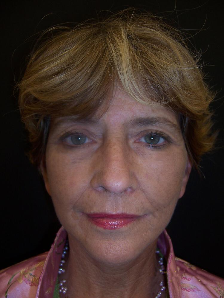 Deep Plane Facelift (Contour Lift) Before & After Image