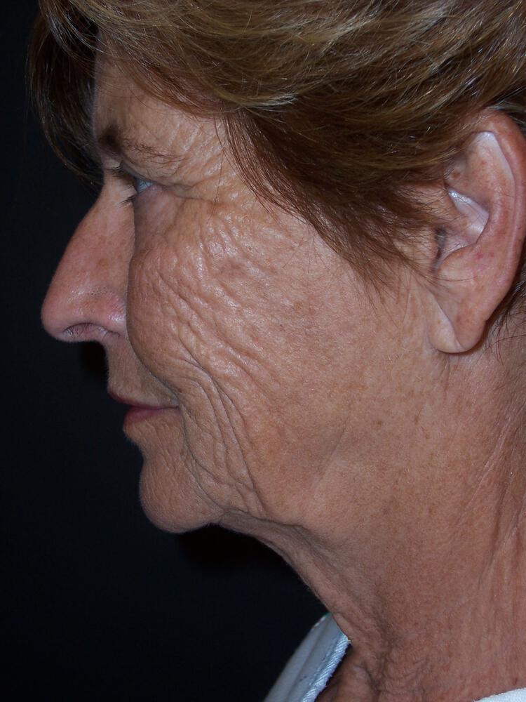 Deep Plane Facelift (Contour Lift) Before & After Image