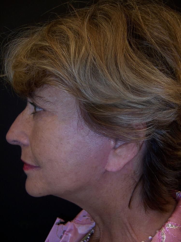 Deep Plane Facelift (Contour Lift) Before & After Image