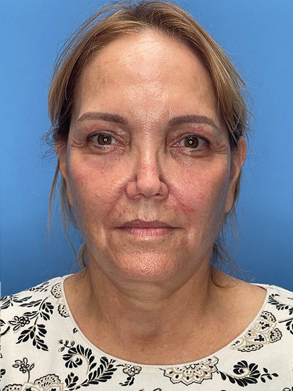 Deep Plane Facelift (Contour Lift) Before & After Image