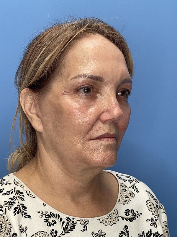 Deep Plane Facelift (Contour Lift) Before & After Image