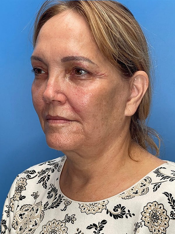 Deep Plane Facelift (Contour Lift) Before & After Image