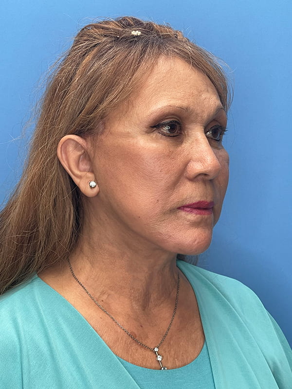 Deep Plane Facelift (Contour Lift) Before & After Image