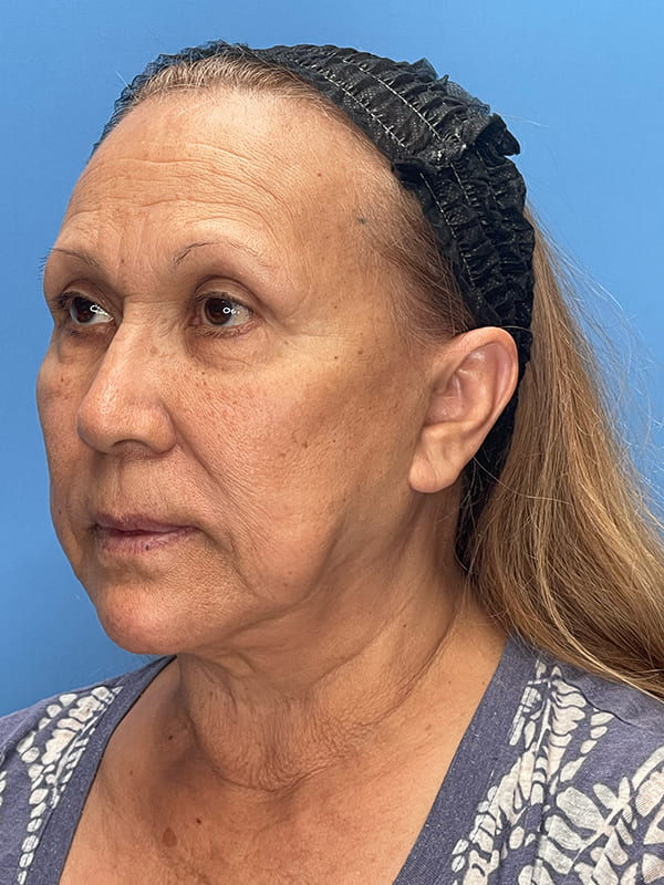 Deep Plane Facelift (Contour Lift) Before & After Image