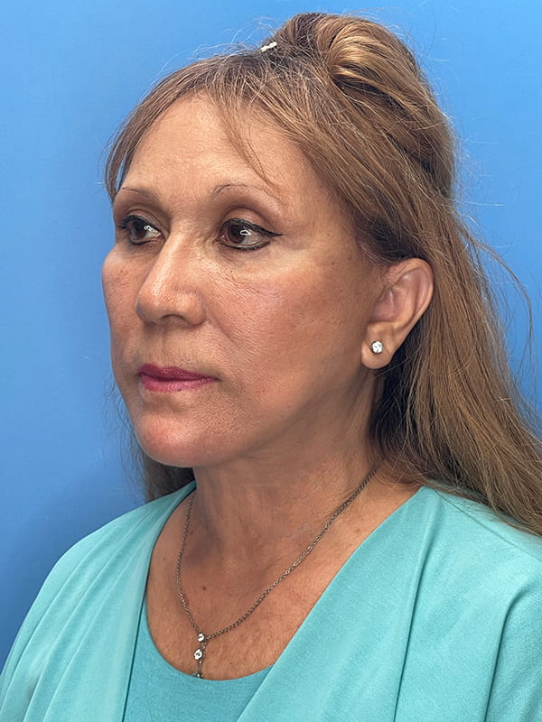 Deep Plane Facelift (Contour Lift) Before & After Image