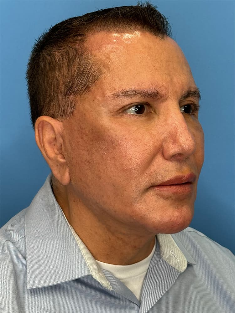 Deep Plane Facelift (Contour Lift) Before & After Image