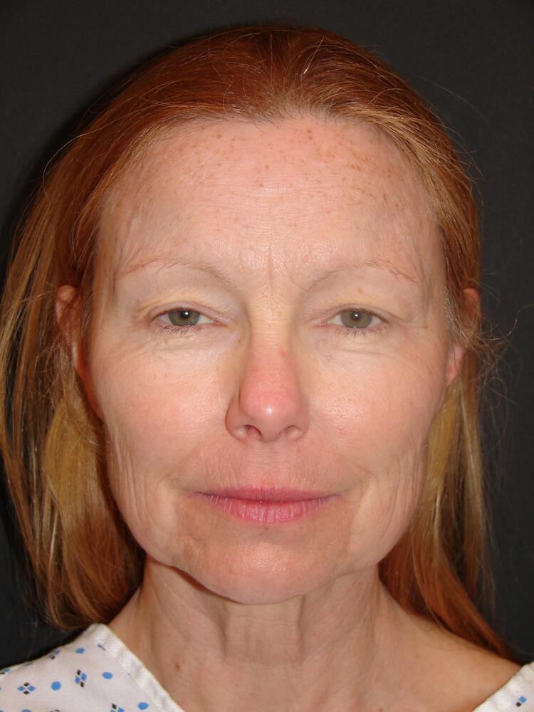 Deep Plane Facelift (Contour Lift) Before & After Image