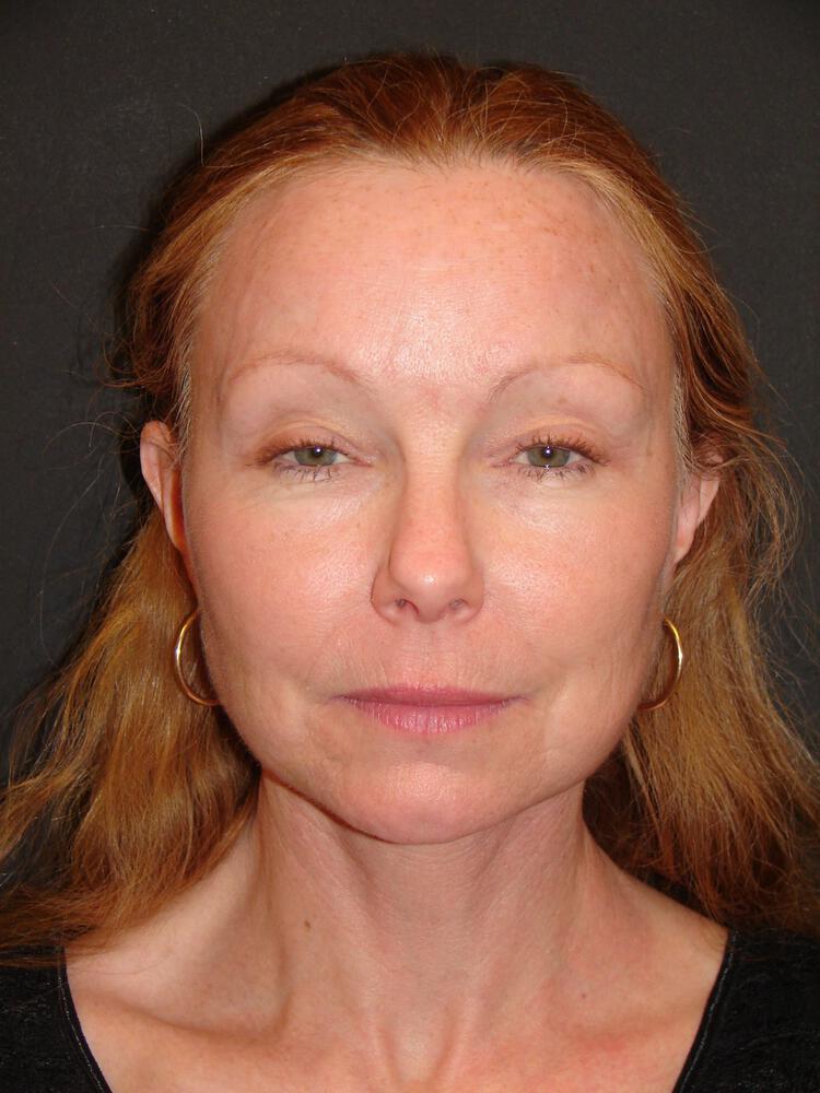 Deep Plane Facelift (Contour Lift) Before & After Image