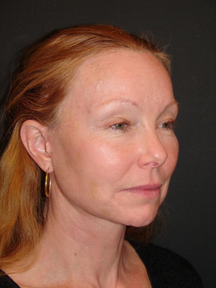 Deep Plane Facelift (Contour Lift) Before & After Image