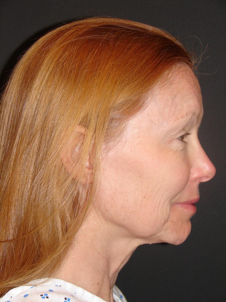 Deep Plane Facelift (Contour Lift) Before & After Image