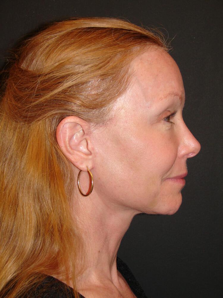 Deep Plane Facelift (Contour Lift) Before & After Image