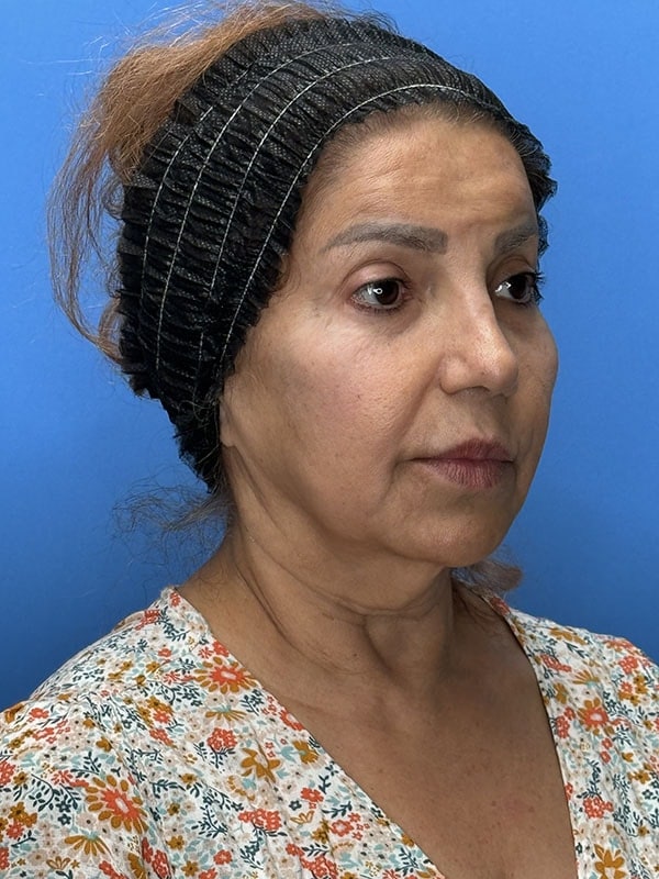 Deep Plane Facelift (Contour Lift) Before & After Image