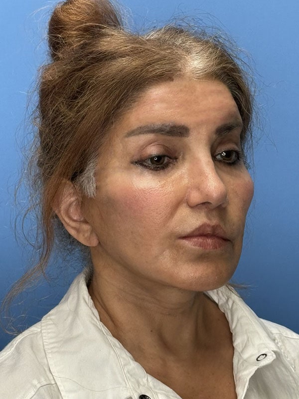 Deep Plane Facelift (Contour Lift) Before & After Image