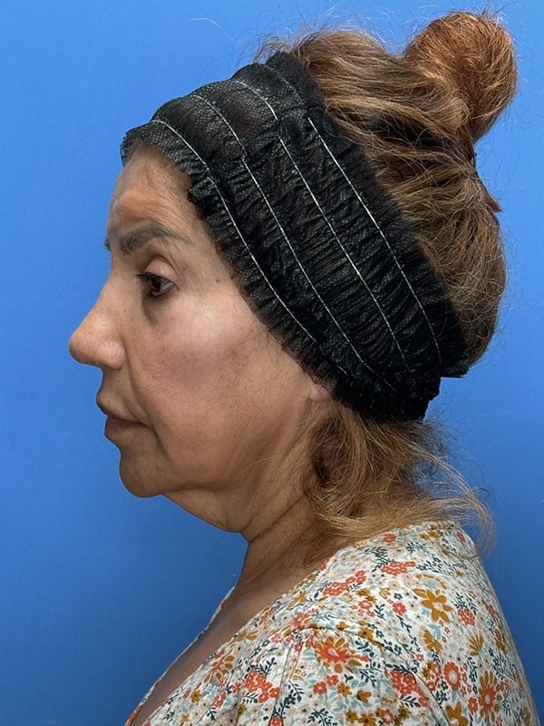 Deep Plane Facelift (Contour Lift) Before & After Image