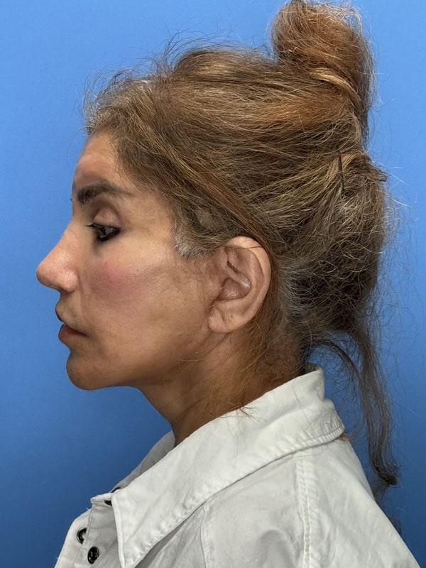 Deep Plane Facelift (Contour Lift) Before & After Image