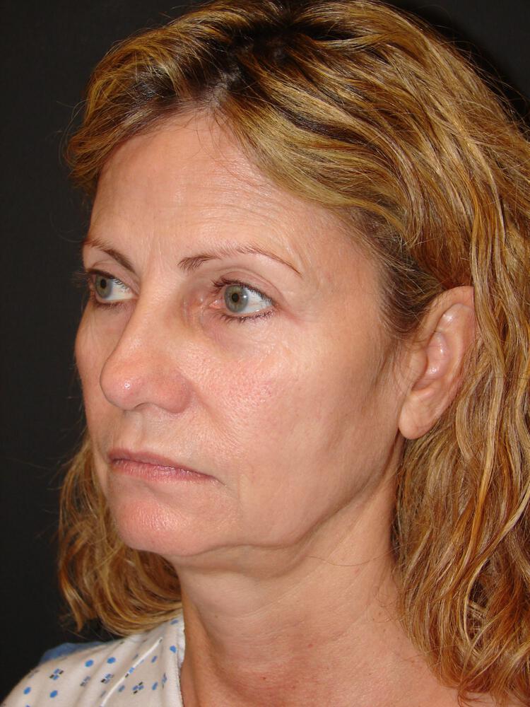 Deep Plane Facelift (Contour Lift) Before & After Image