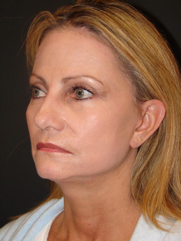 Deep Plane Facelift (Contour Lift) Before & After Image