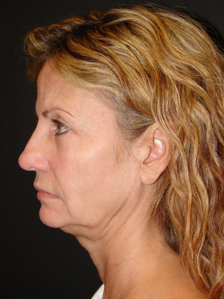 Deep Plane Facelift (Contour Lift) Before & After Image