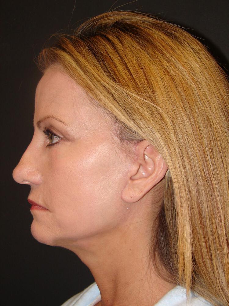 Deep Plane Facelift (Contour Lift) Before & After Image