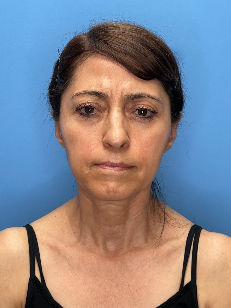 Deep Plane Facelift (Contour Lift) Before & After Image