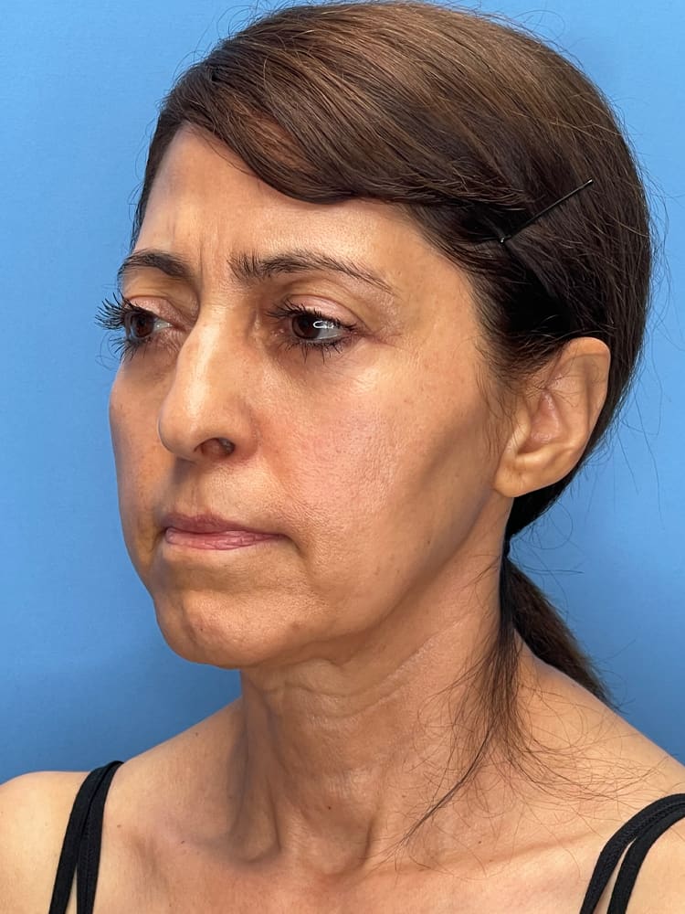 Deep Plane Facelift (Contour Lift) Before & After Image