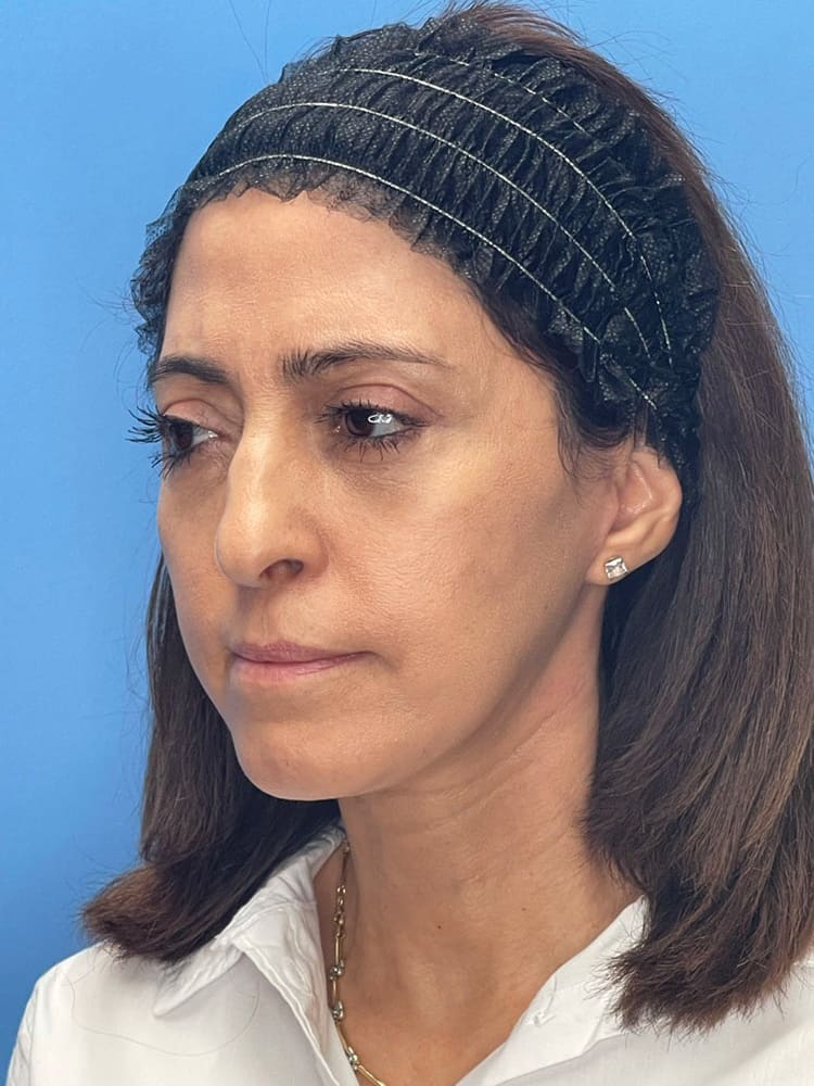 Deep Plane Facelift (Contour Lift) Before & After Image