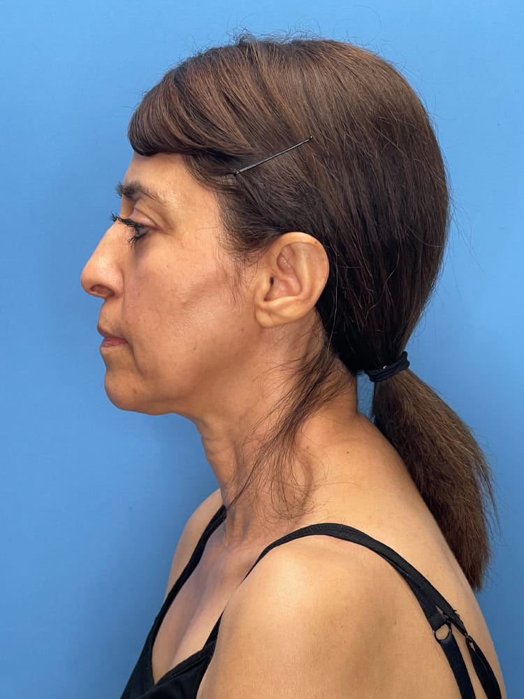 Deep Plane Facelift (Contour Lift) Before & After Image