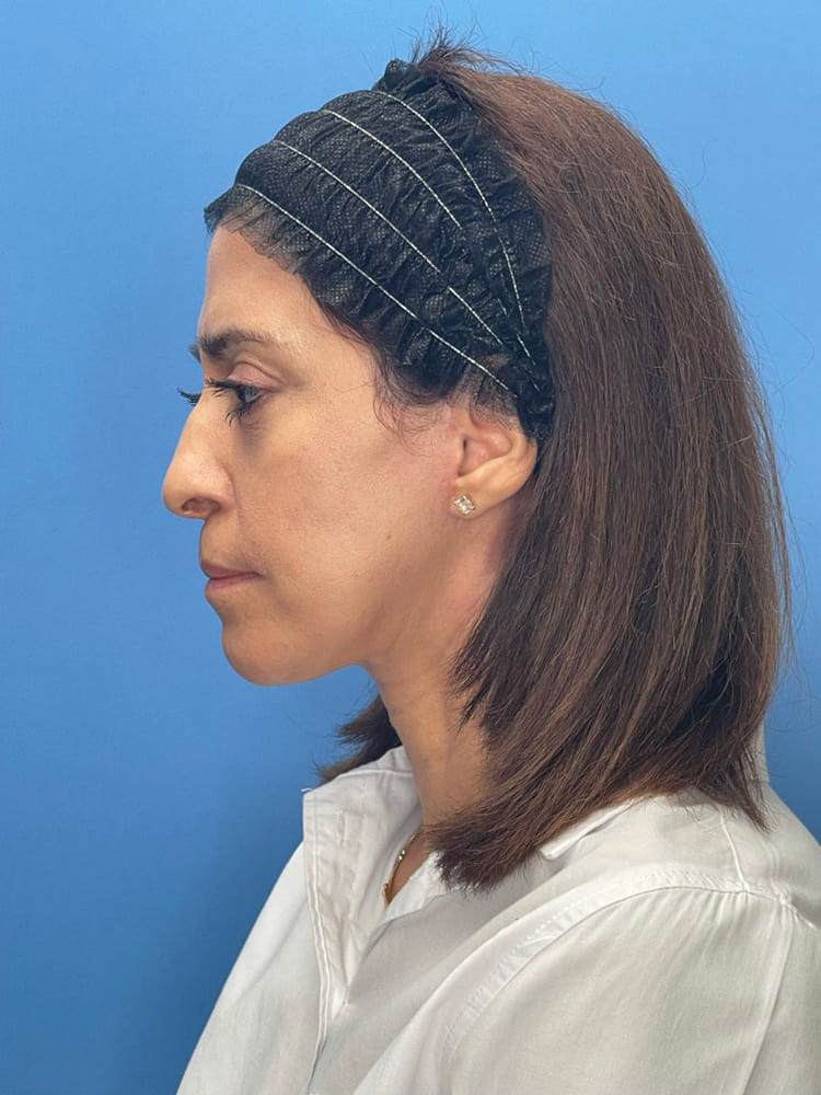 Deep Plane Facelift (Contour Lift) Before & After Image