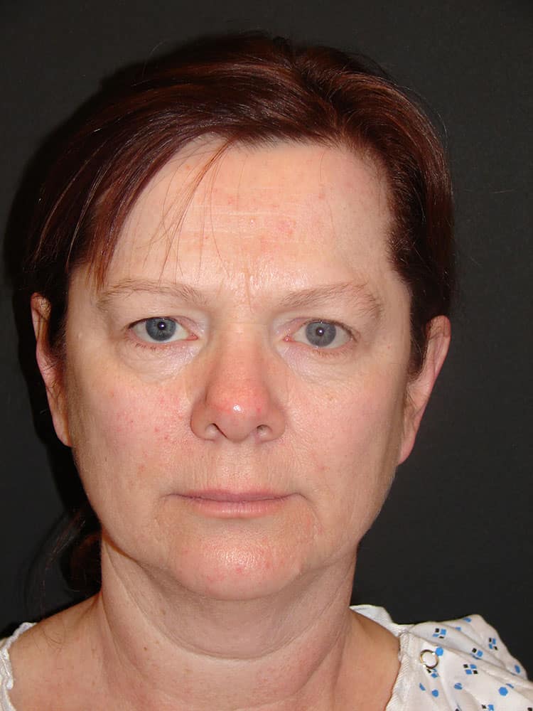 Deep Plane Facelift (Contour Lift) Before & After Image