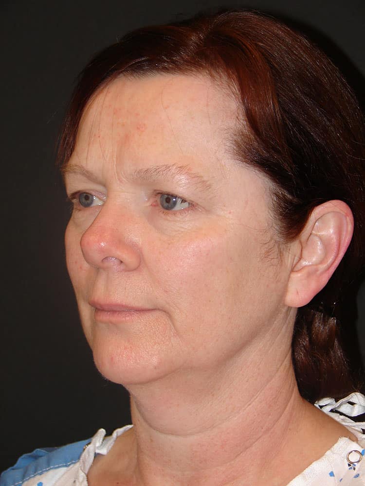 Deep Plane Facelift (Contour Lift) Before & After Image