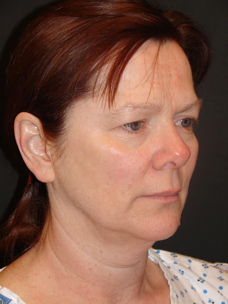 Deep Plane Facelift (Contour Lift) Before & After Image