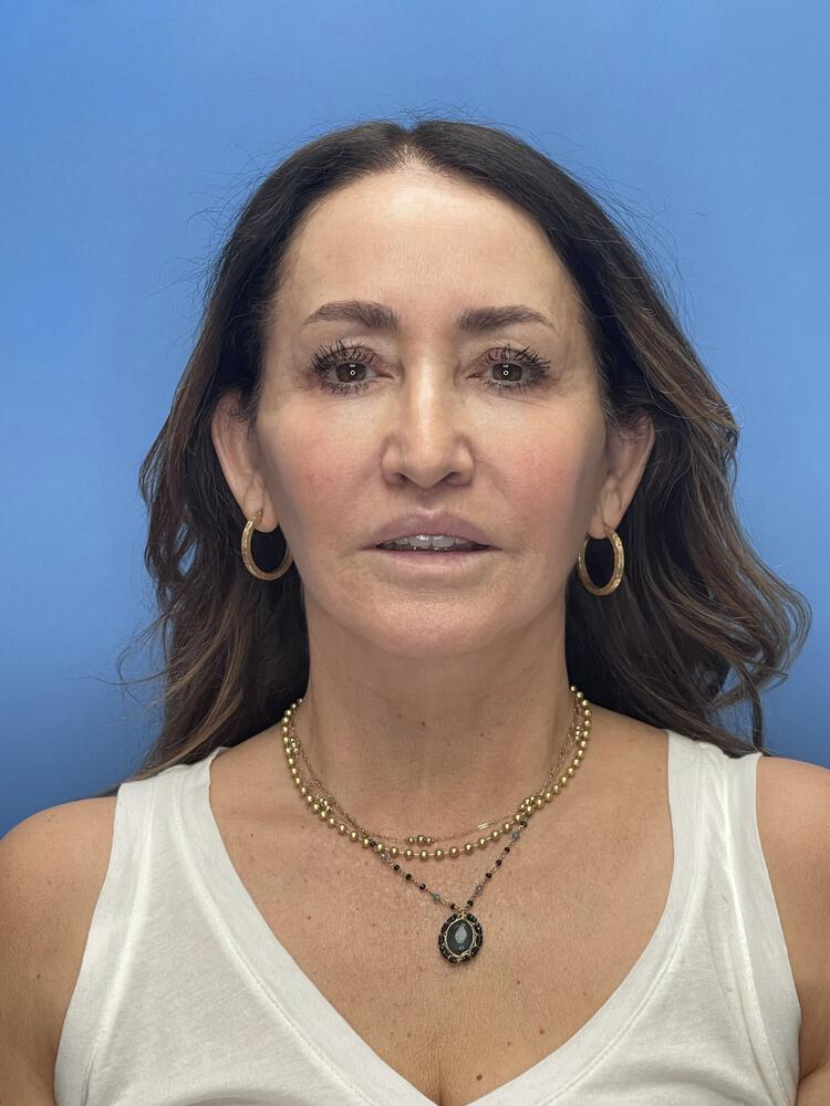 Deep Plane Facelift (Contour Lift) Before & After Image