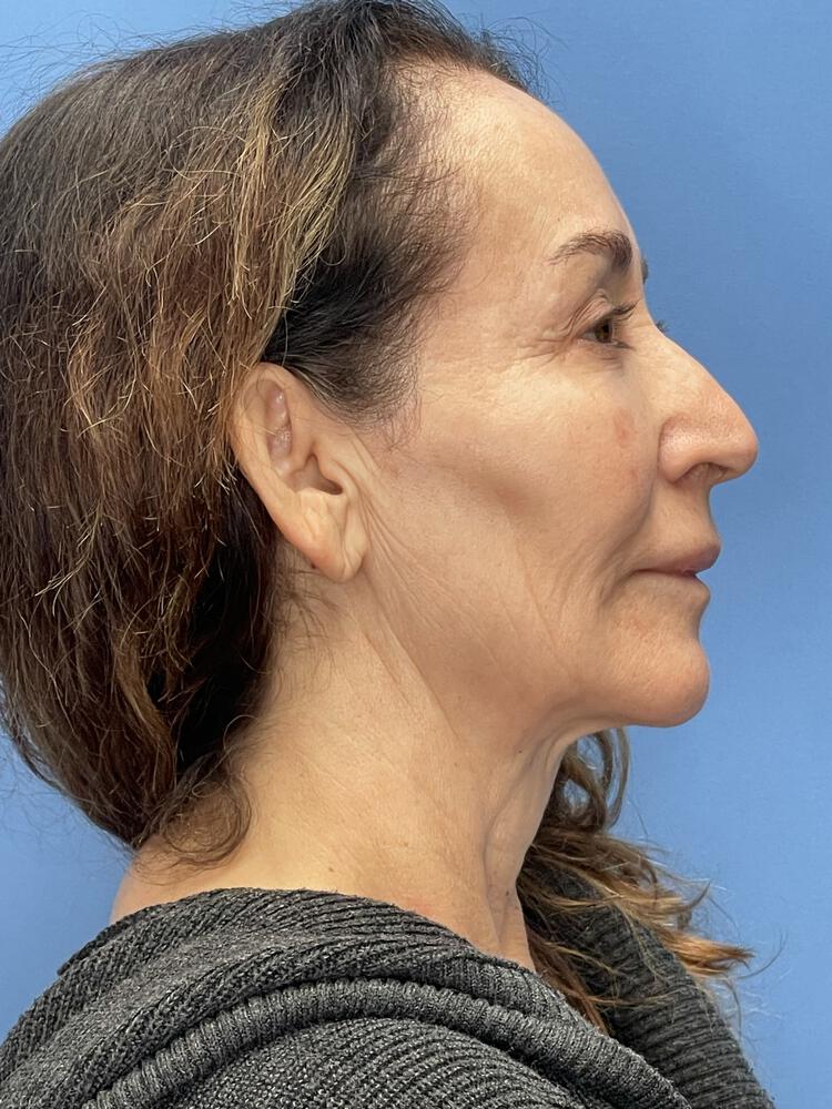 Deep Plane Facelift (Contour Lift) Before & After Image