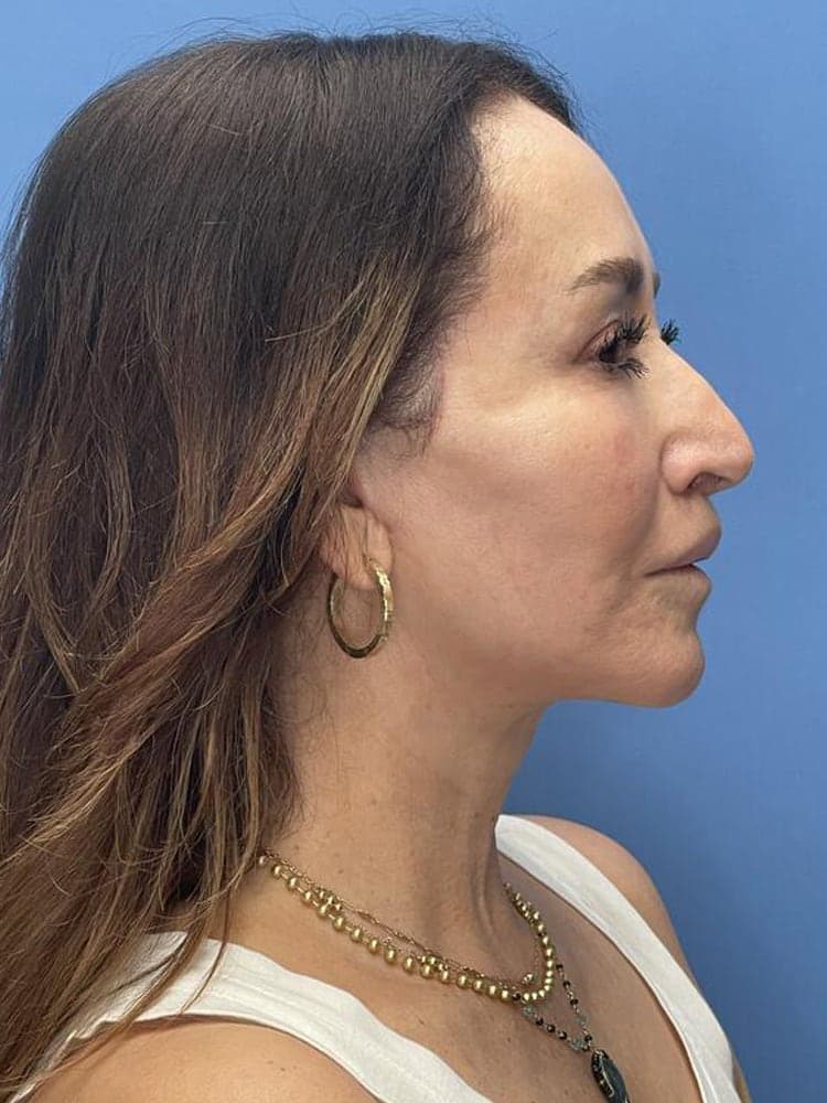 Deep Plane Facelift (Contour Lift) Before & After Image