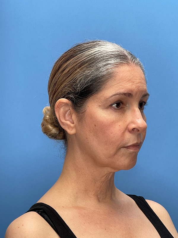 Deep Plane Facelift (Contour Lift) Before & After Image