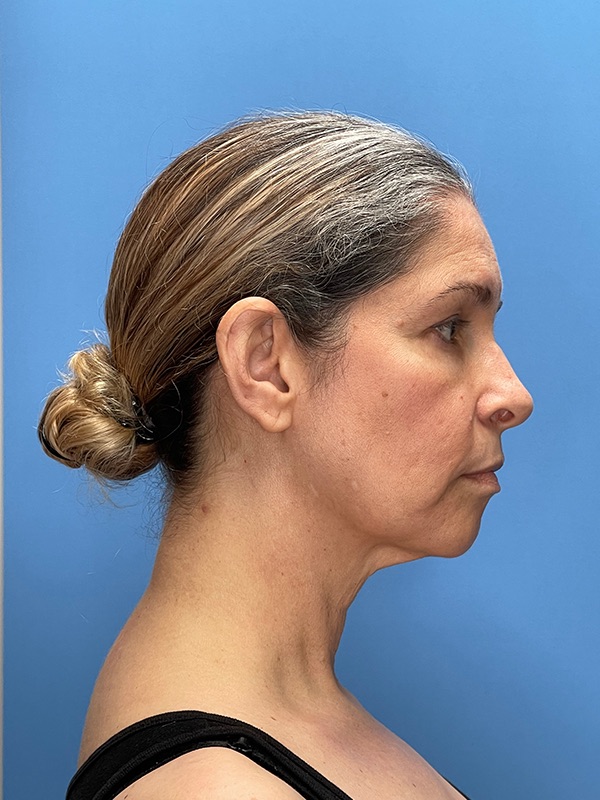 Deep Plane Facelift (Contour Lift) Before & After Image