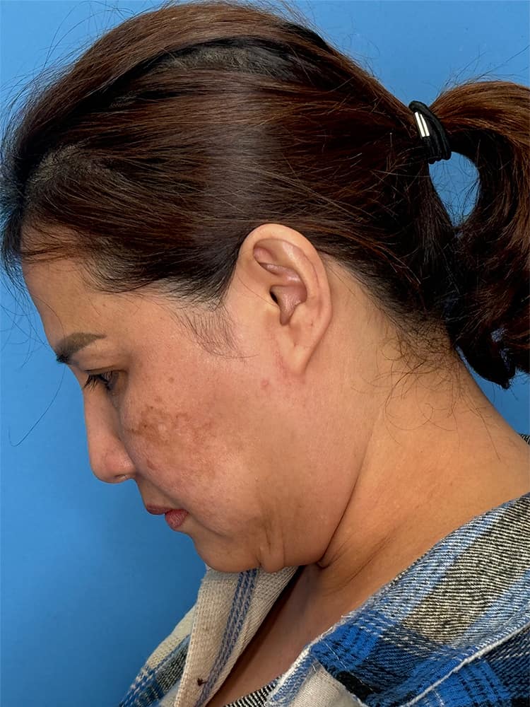 Deep Plane Facelift (Contour Lift) Before & After Image