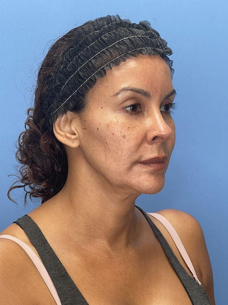 Deep Plane Facelift (Contour Lift) Before & After Image