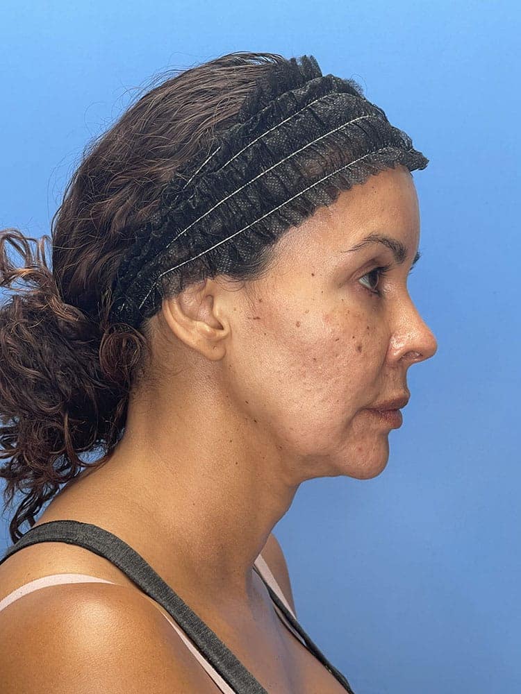 Deep Plane Facelift (Contour Lift) Before & After Image