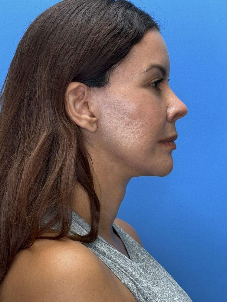 Deep Plane Facelift (Contour Lift) Before & After Image