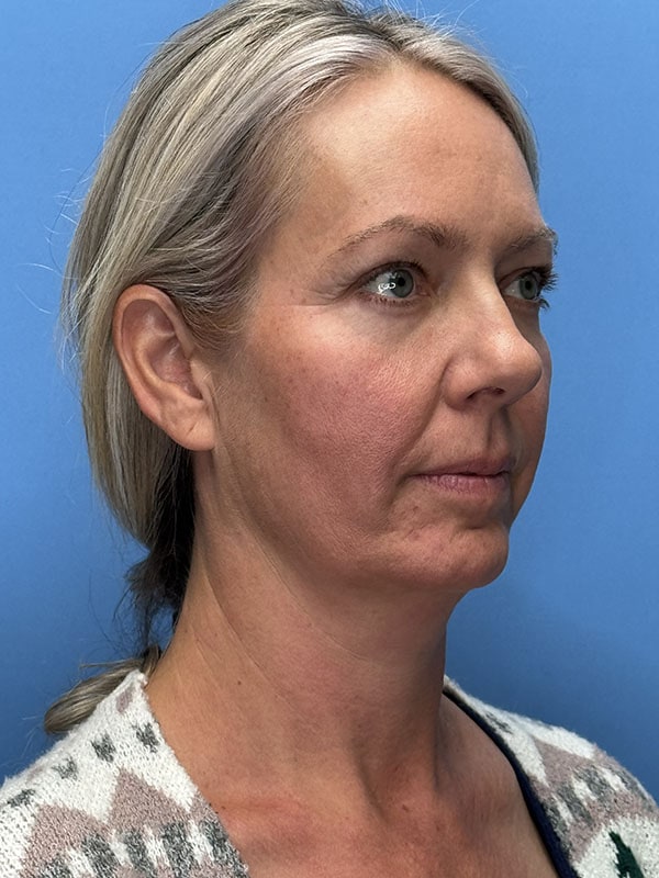 Deep Plane Facelift (Contour Lift) Before & After Image