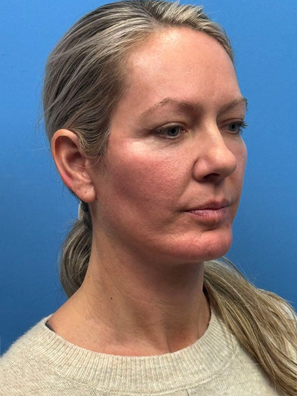 Deep Plane Facelift (Contour Lift) Before & After Image