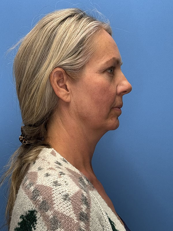 Deep Plane Facelift (Contour Lift) Before & After Image