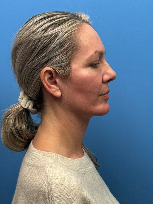 Deep Plane Facelift (Contour Lift) Before & After Image