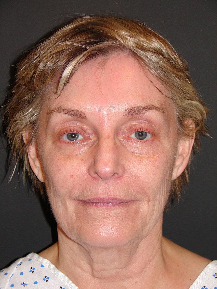 Facelift Before & After Image